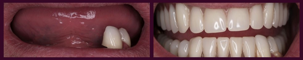 Immediate Dentures After Extraction Phoenix AZ 85008
